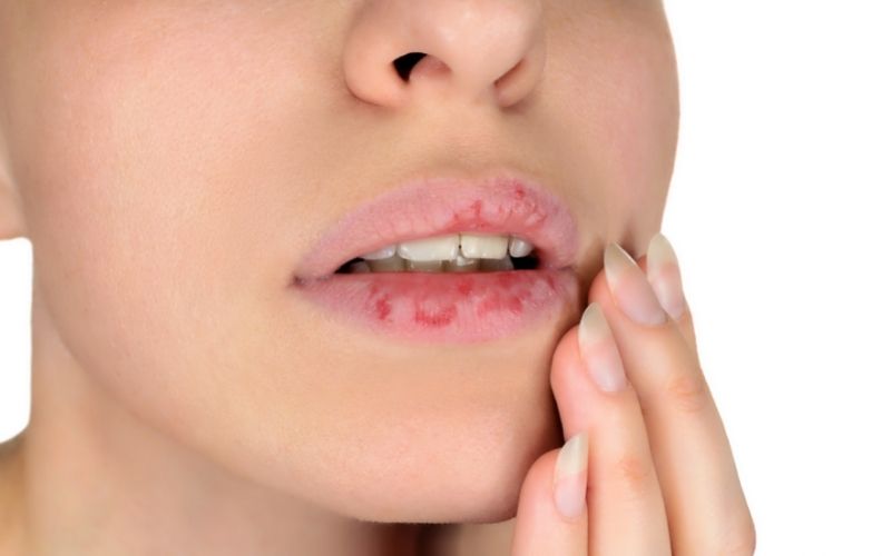 Eczema On Lips: 8 Trusted Treatments - CLEAR SKIN REGIME