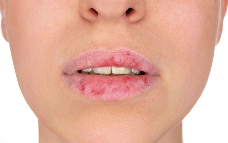 Eczema On Lips 8 Trusted Treatments Clear Skin Regime