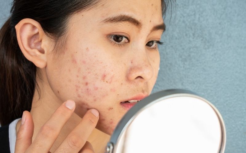 fungal acne vs closed comedones