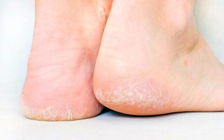 Cracked Heels: Simple Ways To Cure