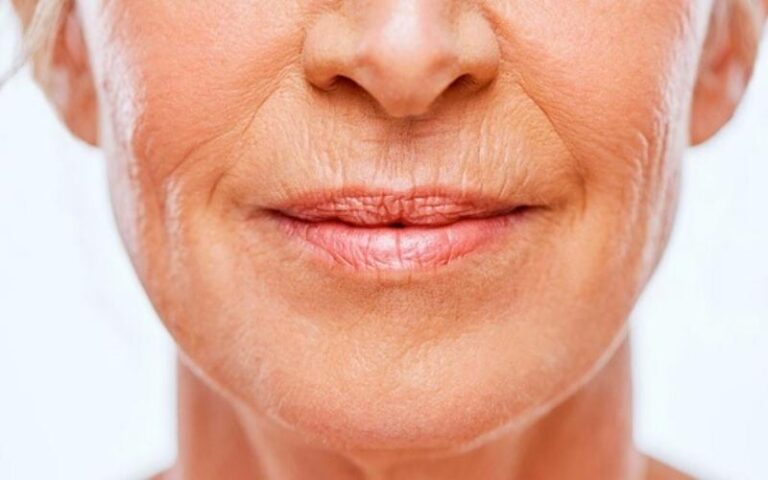 10 Ways to Get Rid of Cheek Wrinkles Naturally