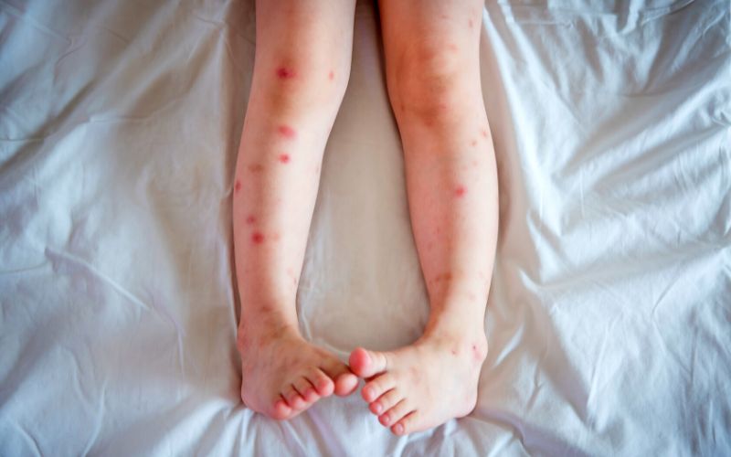 Dark Spots On Legs
