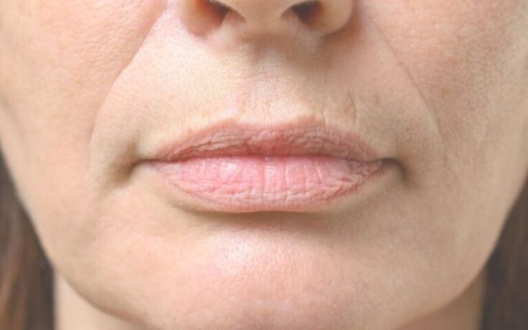 Got Wrinkles Around Your Mouth? Here Are Simple Tips To Help