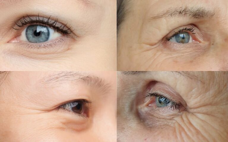 Under-Eye Wrinkles And Fine Lines At Different Ages