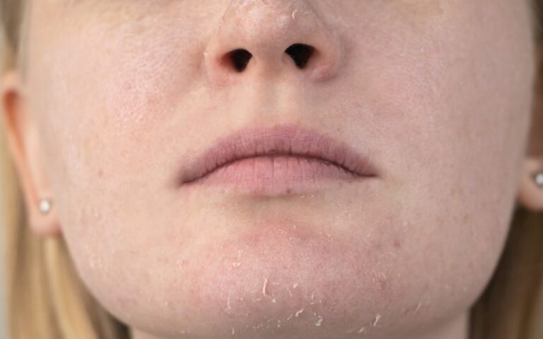 Some Tips To Treat Dry Skin Around Your Mouth