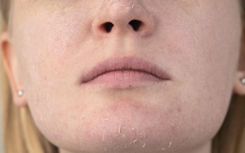 dry-skin-around-the-mouth-causes-treatment-and-remedies