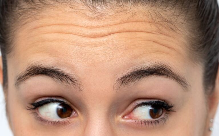How To Banish Forehead Lines Naturally?