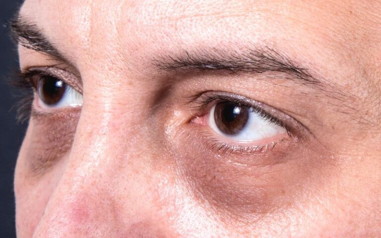 Speedy Techniques To Get Rid Of Under-Eye Dark Circles