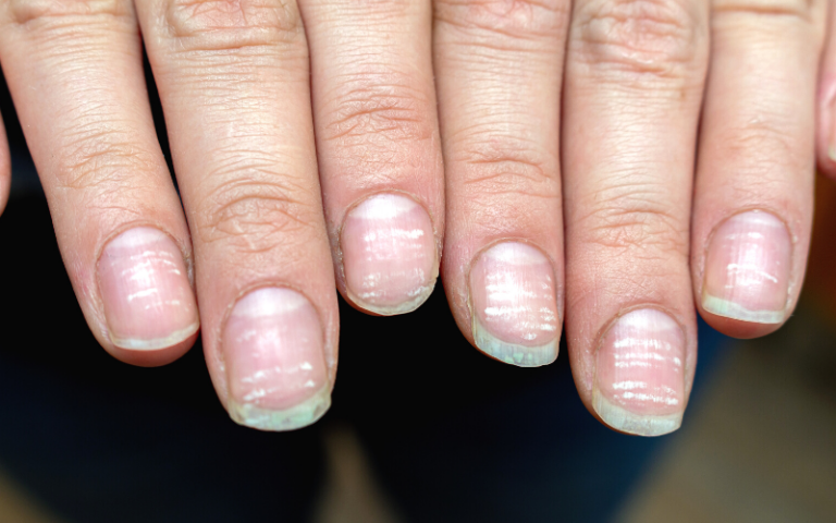 The Meaning Of Those White Spots On Nails