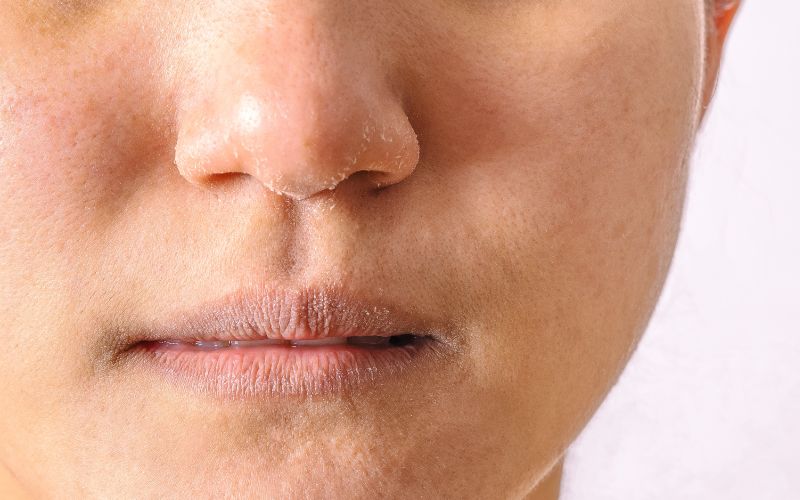 Dry Skin Around The Nose