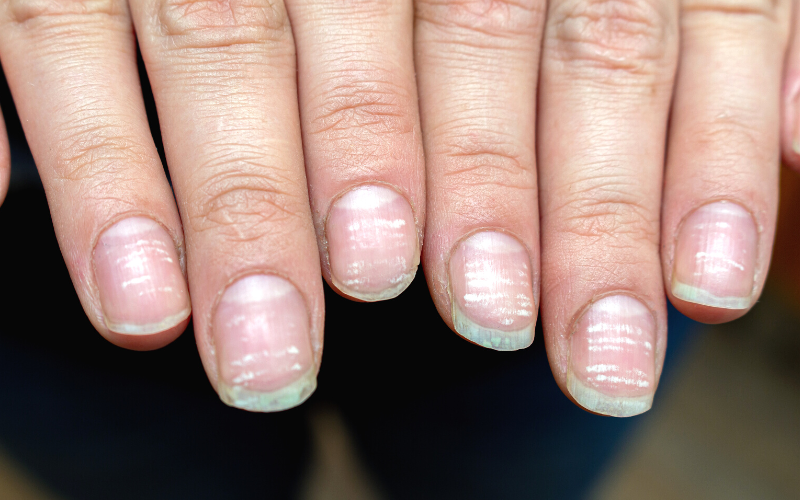 The Meaning Of Those White Spots On Nails CLEAR SKIN REGIME