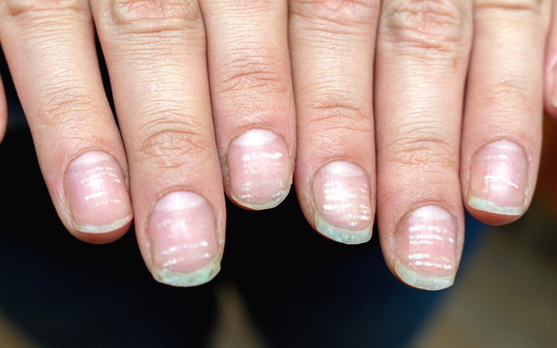 white-spots-on-fingernails-cause-treatment-and-myths-skincarederm