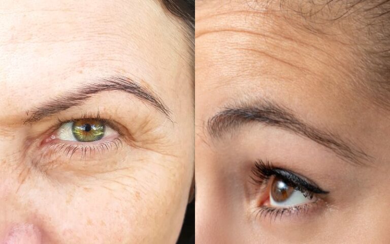 Wrinkles vs. Fine Lines: What They Are And How To Get Rid Of