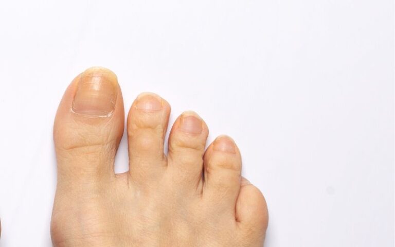 Health Effects And Treatment Options For Yellow Toenails