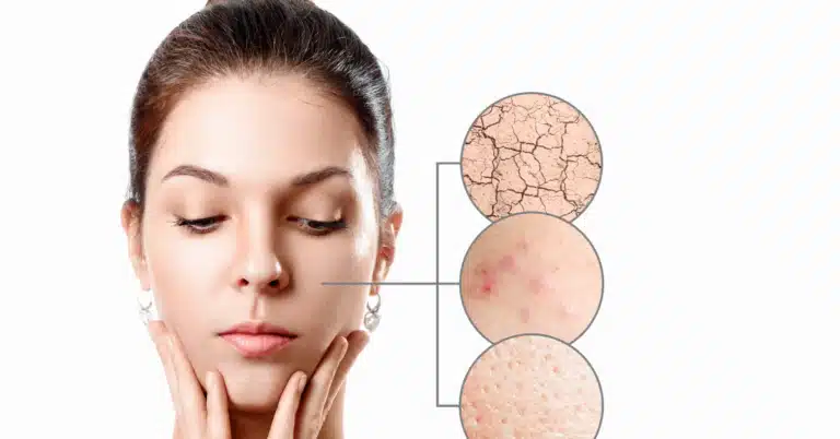 7 Reasons You Have Dry Skin Even After Moisturizing