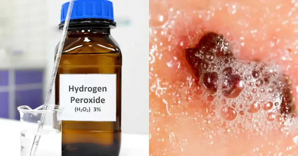 Hydrogen Peroxide using on folliculitis area