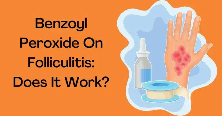 Benzoyl Peroxide On Folliculitis: Does It Work?