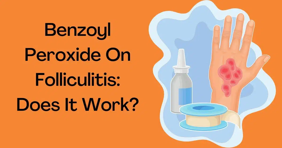 Benzoyl Peroxide On Folliculitis