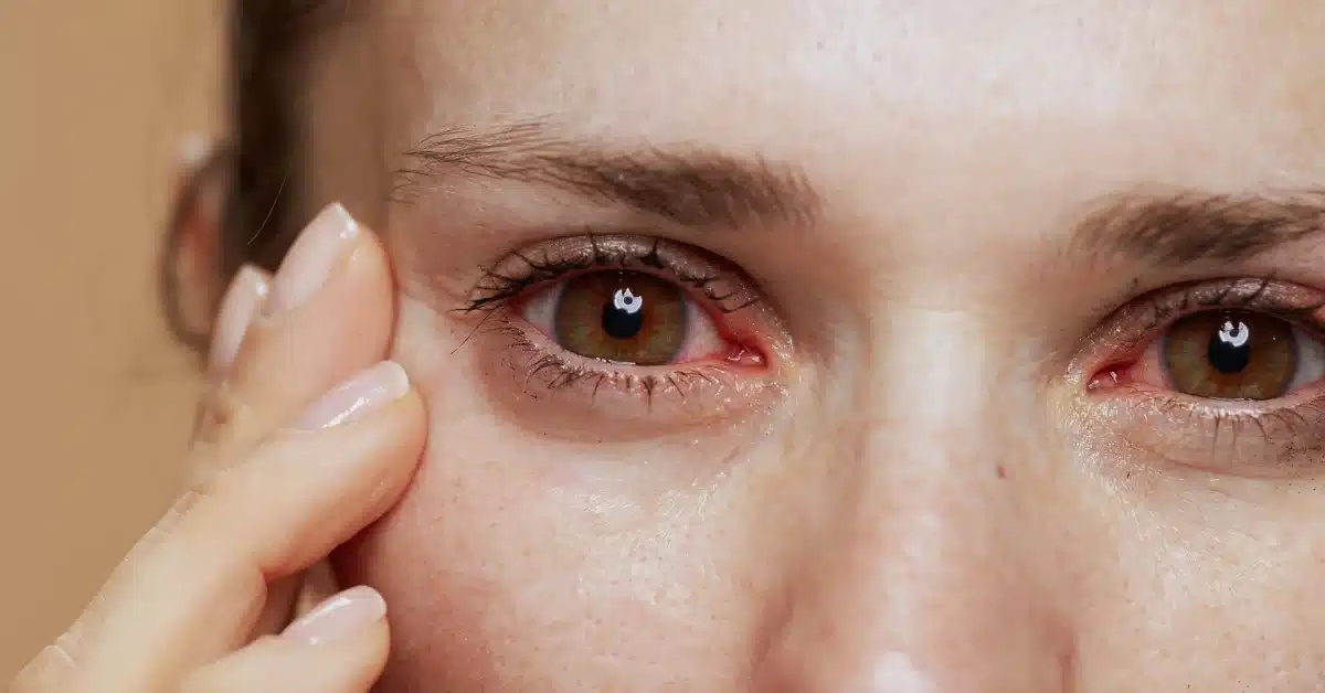 Eye makeup allergy