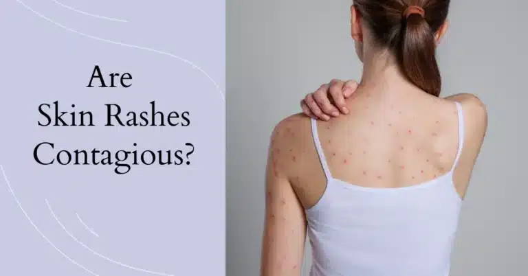 Behind The Blotches: Are Skin Rashes Contagious?