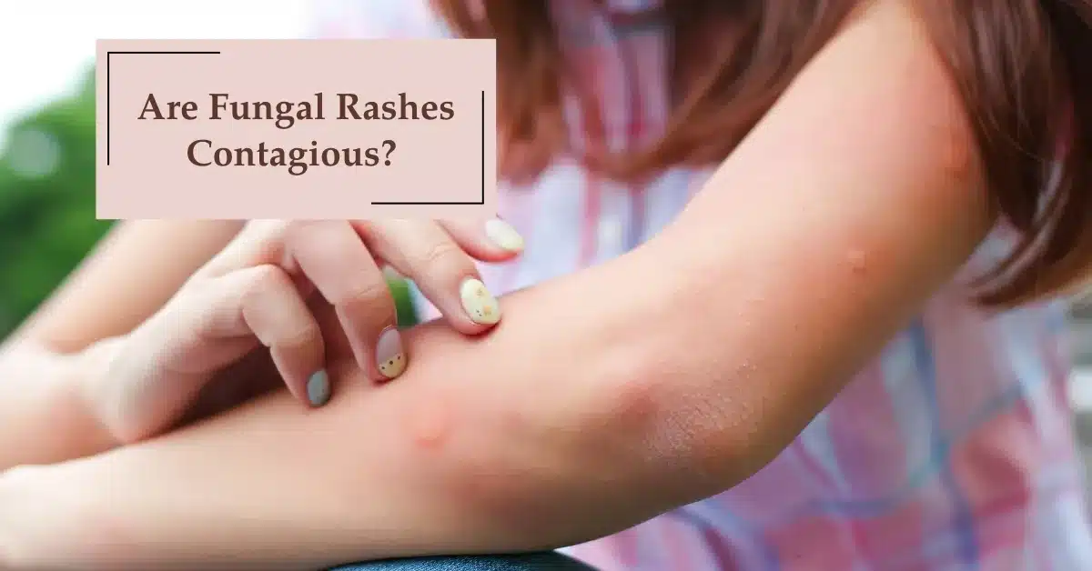 Fungal Rashes